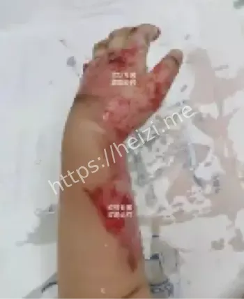 咬伤感染医疗急救